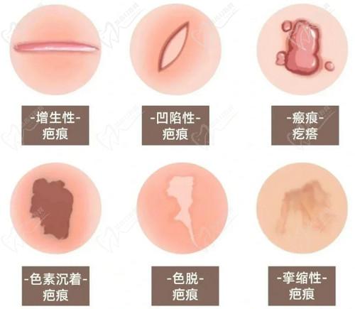 武汉同 济医院疤痕修复手术价格