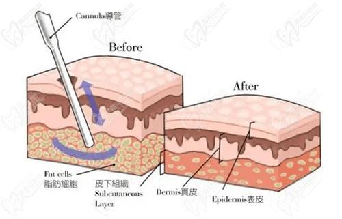 武汉同 济医院优脂塑抽脂技术成熟