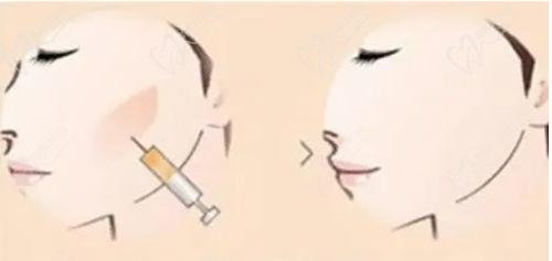 武汉同 济医院优脂塑抽脂的医生技术高超