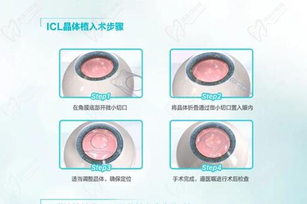 近视眼矫正价格一览表