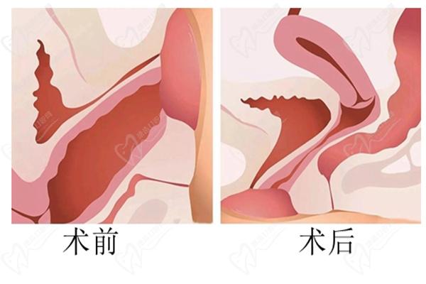 上海九龙医院王缨做MEC 3D生物束带微创紧缩术怎么样