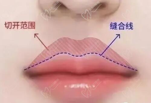 深圳福雅胡俊杰人中缩短价格