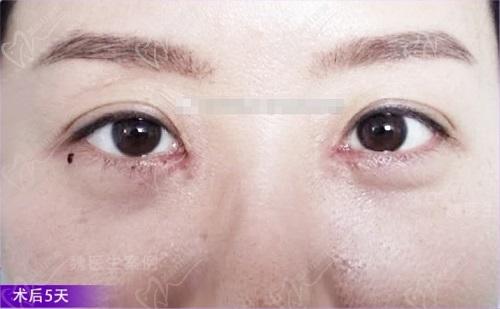 魏志香内眼角修复实例