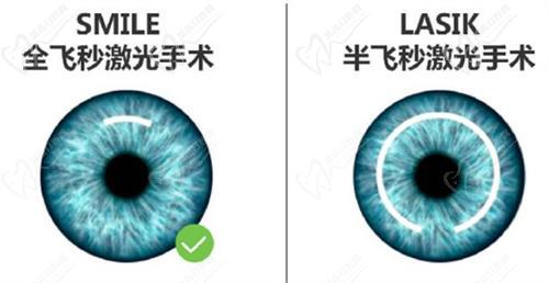 昆明眼科医院近视手术做的好吗