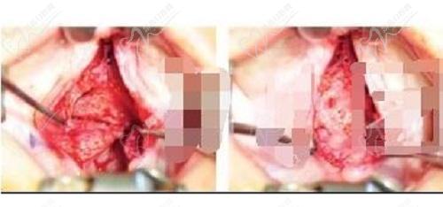 李精韬做的唇裂手术怎么样？