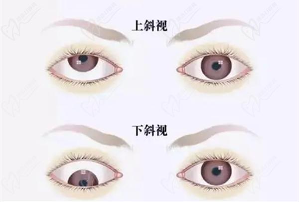 斜视