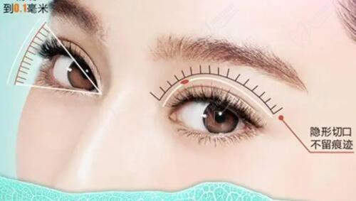 成都雷蕾医生双眼皮怎么样？