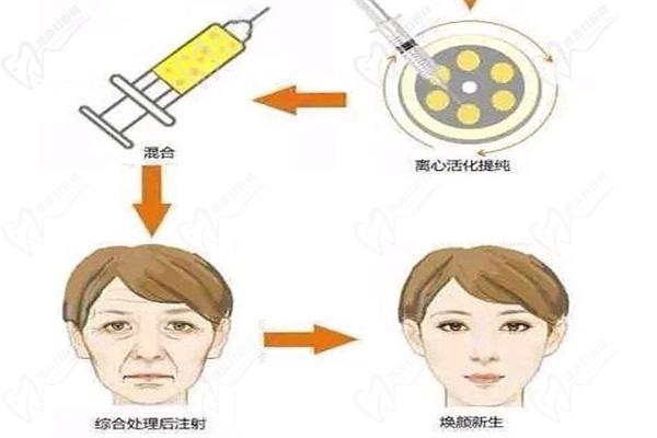 谢卫国脂肪填充