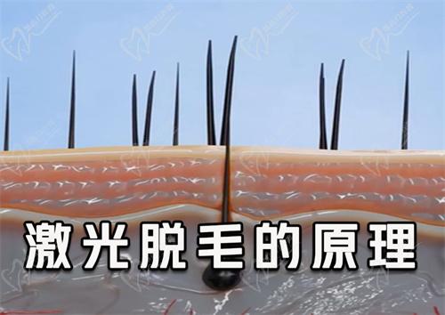 激光脱毛的原理