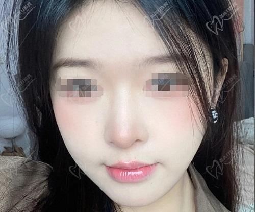 金柱翰磨骨口碑实例