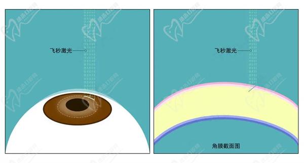 邵阳近视眼手术多少钱