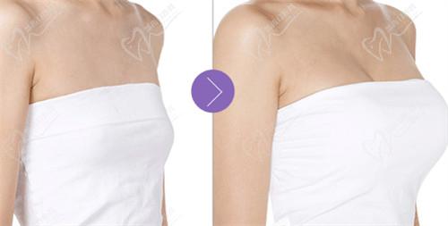 西安李高峰隆胸价格贵吗？ 