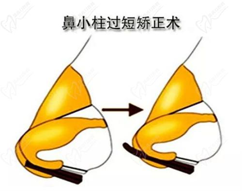 武汉同 济吴辉医生做的膨体隆鼻口碑不错