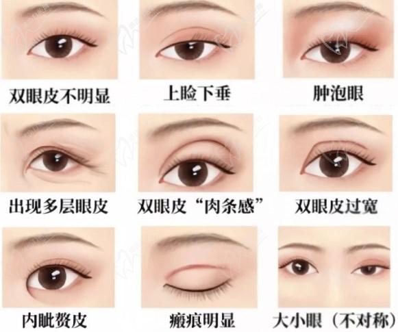 卢美均做双眼皮多少钱啊