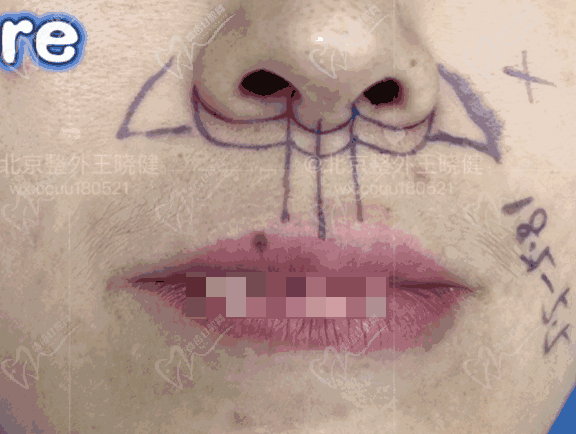 王晓健人中缩短术成效怎么样