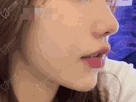 王晓健人中缩短术范例