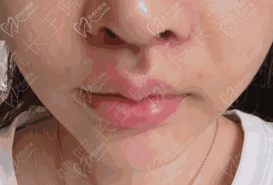 王晓健人中窝加深