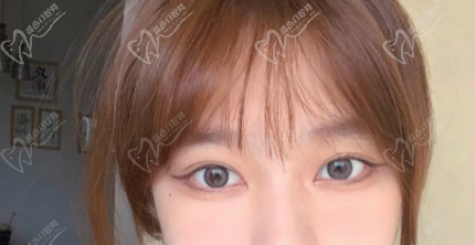 卢美均星眸眼双眼皮是从哪里切