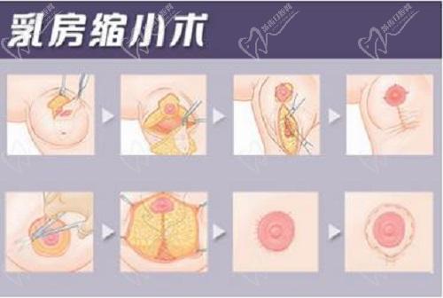 南京美莱夏建军缩胸手术