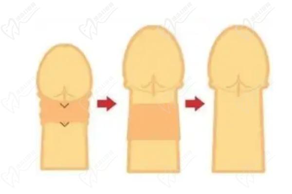 男科张国喜做男性假体植入术好不好