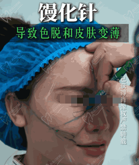 钟杰光医生取异物要多少钱