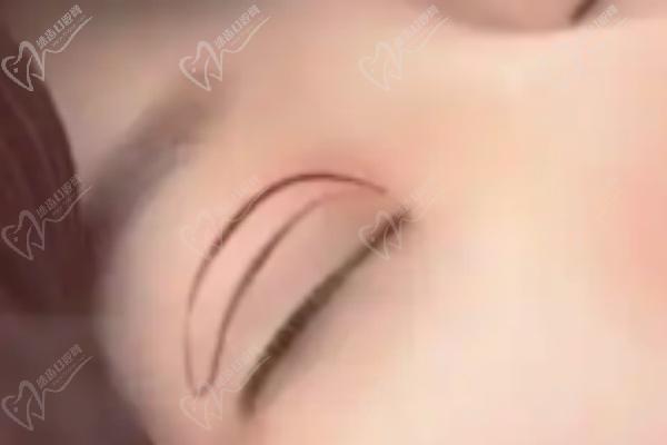 高亚东双眼皮缝合方法咋样