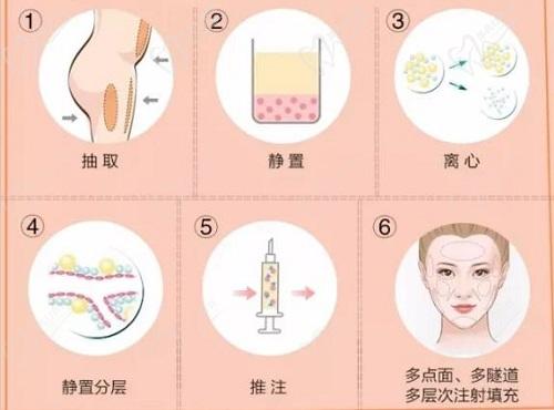 南京华美沈正宇脂肪填充怎么样