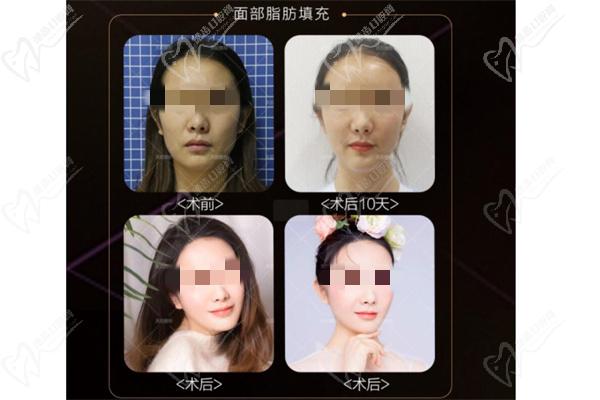 陈三群手术案 例