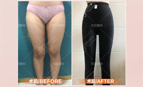 陈三群手术案 例