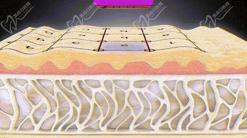 武汉美莱申玲的热玛吉技术很不错 武汉美莱申玲的热玛吉技术很不错