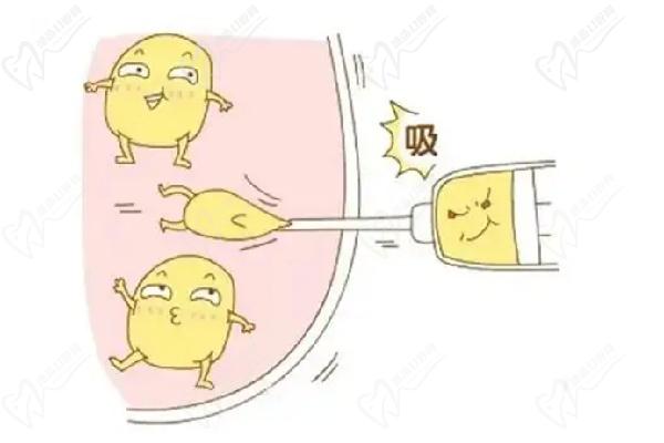 上海吴友勇抽脂怎么样 上海吴友勇抽脂怎么样