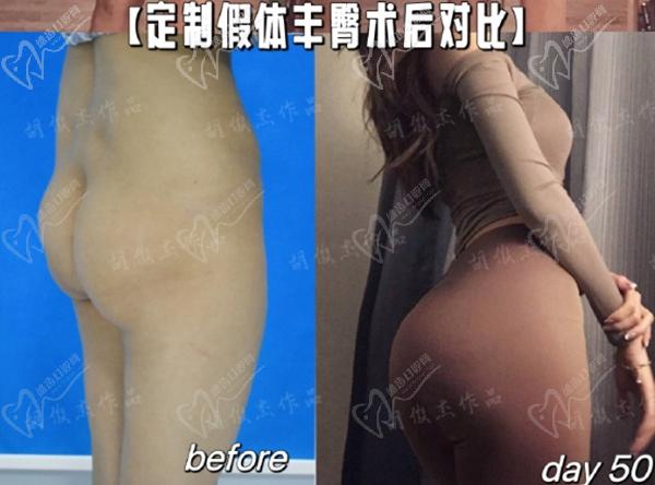 胡俊杰假体丰臀真人范例分享