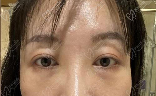 师丽丽双眼皮修复<span style=