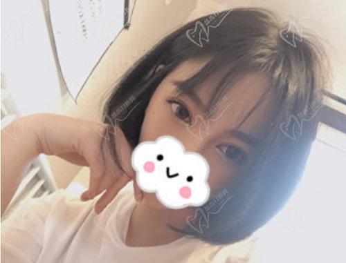 师丽丽双眼皮修复实例
