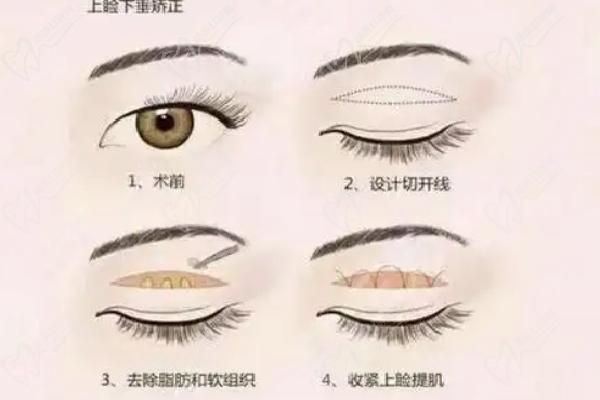 北京 301医院整形科双眼皮价格表2025 北京 301医院整形科双眼皮价格表2025