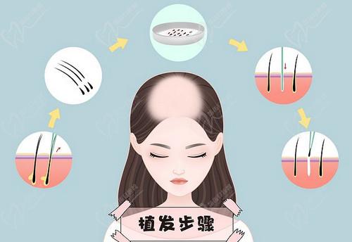 植发医生童靖做植发技术高超