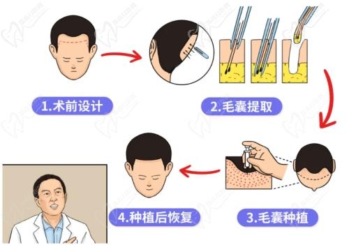 植发医生童靖做植发技术娴熟