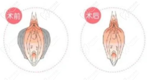 王艺洁医生做私密整形技术好
