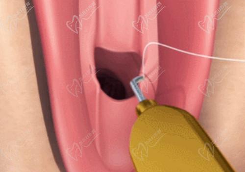 武汉真爱龚美云做私密手术技术扎实