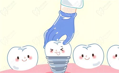 瑞典诺贝尔和iti种植体