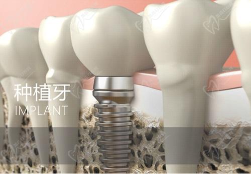 深圳新浩口腔医院种植牙怎么样？