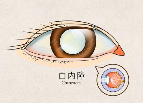 石家庄爱眼眼科医院蒋磊白内障手术做的不错