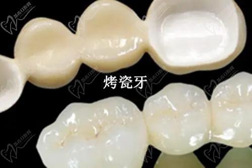 各地区牙齿贴面多少钱？2025价格表：