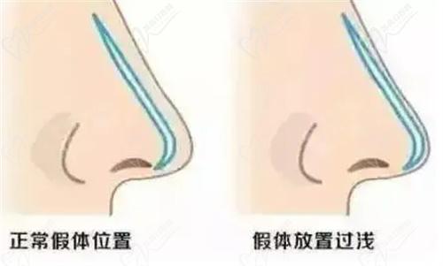 武汉亚韩美容整形医院假体隆鼻价格