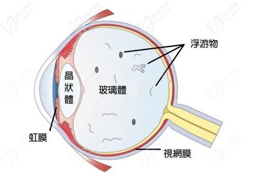 后巩膜加固术后视力能提高多少