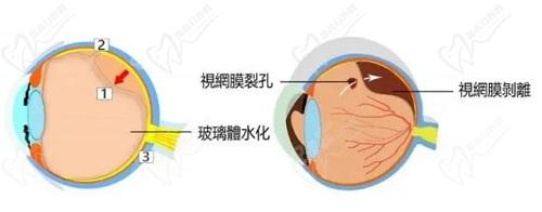 后巩膜加固术后视力能提高多少