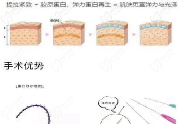 北京美国强生蓝钻鱼骨线 雕价格多少