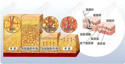 王健医生吸脂技术非常好
