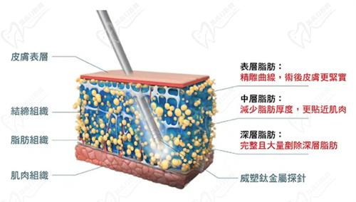 王健医生吸脂技术非常娴熟
