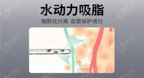 王健医生吸脂结果十分自然